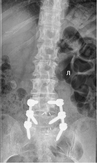 МРТ поясничного отдела позвоночника пациентки после операции.