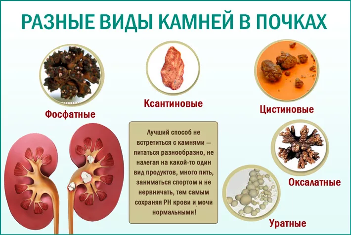 Токсины в почках. Классификация конкрементов при мочекаменной болезни. Мочекаменная болезнь классификация камней. Почечные камни симптомы. Мочекаменная болезнь камни в почках.