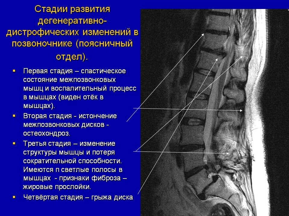 Начальное дегенеративно дистрофические изменения шейного отдела