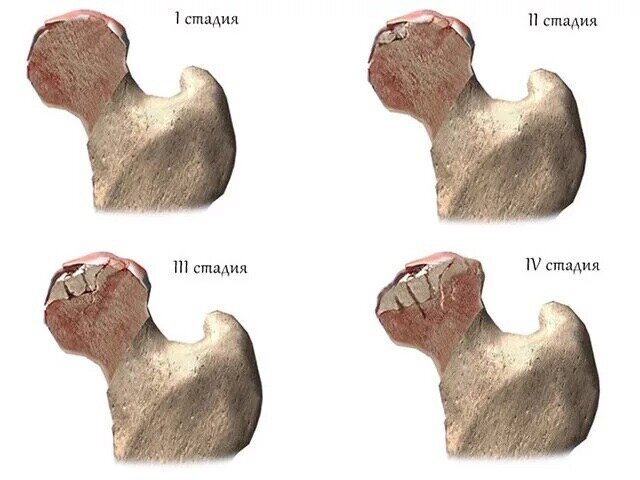 Асептический некроз головки бедренной кости сустава
