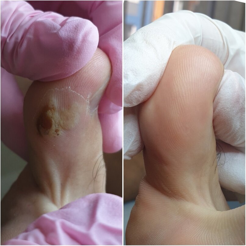 Межпальцевая бородавка