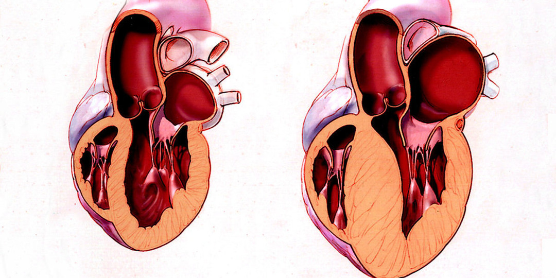 5 фактов о мерцательной аритмии, о которых вы могли не знать