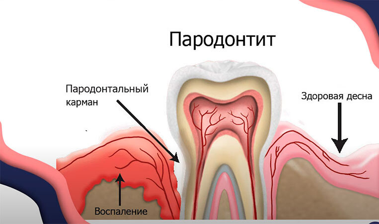 Оголение шейки зуба