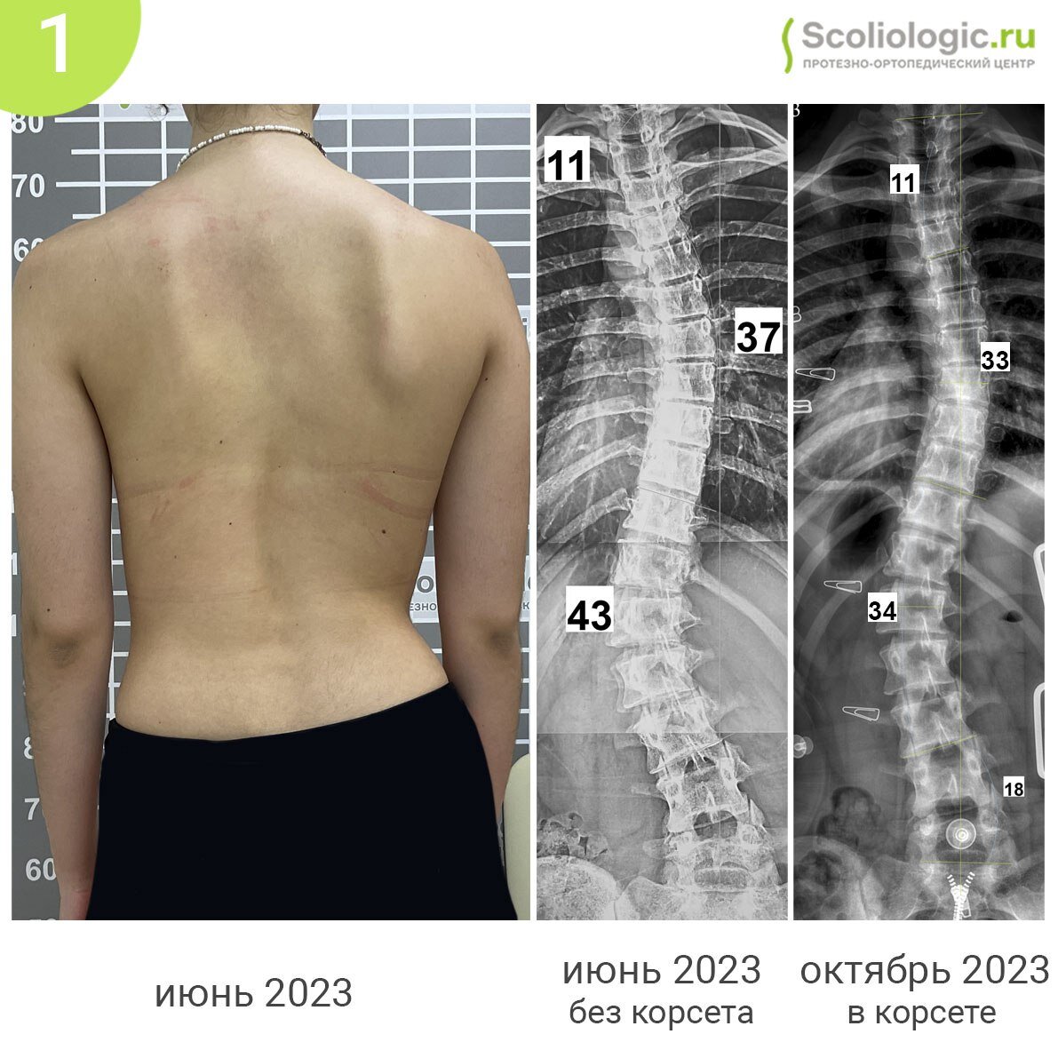Сколиоз 3 степени форум. Корсет для сколиоза. Сколиоз 3 степени 31 градус. Сколиоз 3 степени инвалидность. Искривление позвоночника 3 степени.