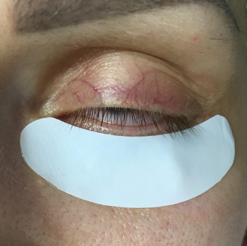 причины покраснения глаз у клиентов от наращивания ресниц