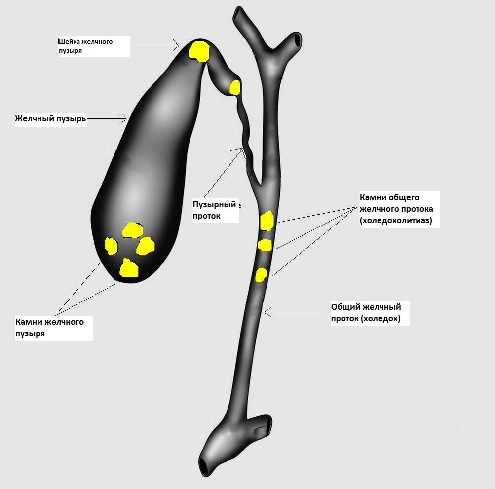 Из за чего появляется желчный пузырь. Камни в протоках желчного пузыря. Конкремент в шейке желчного пузыря. Желчный пузырь холедохолитиаз. Камень в протоке желчного пузыря.