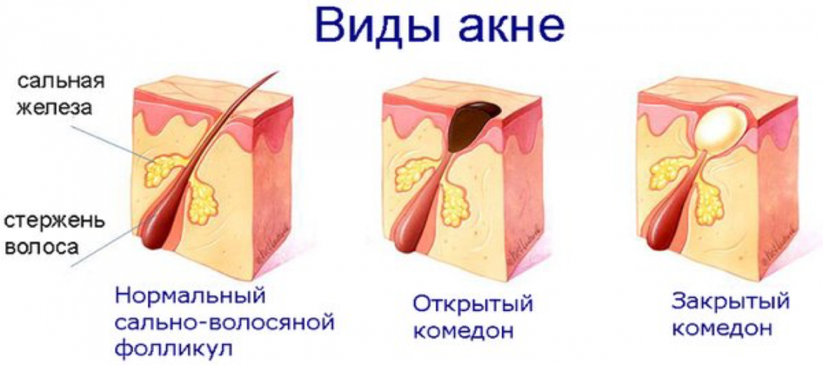 Как можете наблюдать комедоны бывают  различных стадий. Комедоны –  зачастую это черные,  но изначально по природе своей белые. 
 они по размеру сопоставимы и виду с точками на коже.