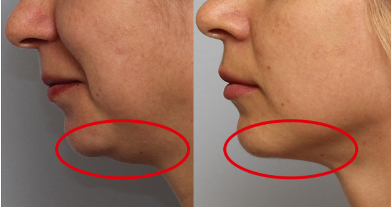 До и после. Очень хороший резултат