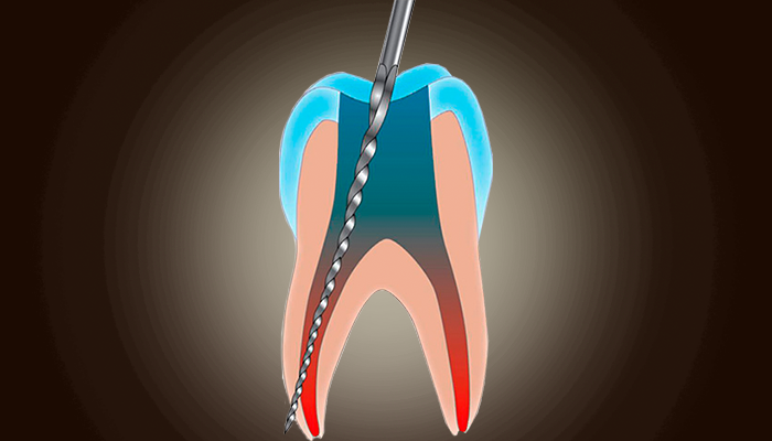 Перфорация корня зуба: что это такое и чем опасно?