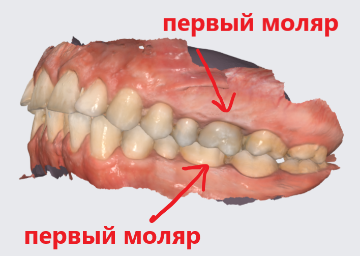 Зубы 2.6 и 3.6 отмечены стрелками.