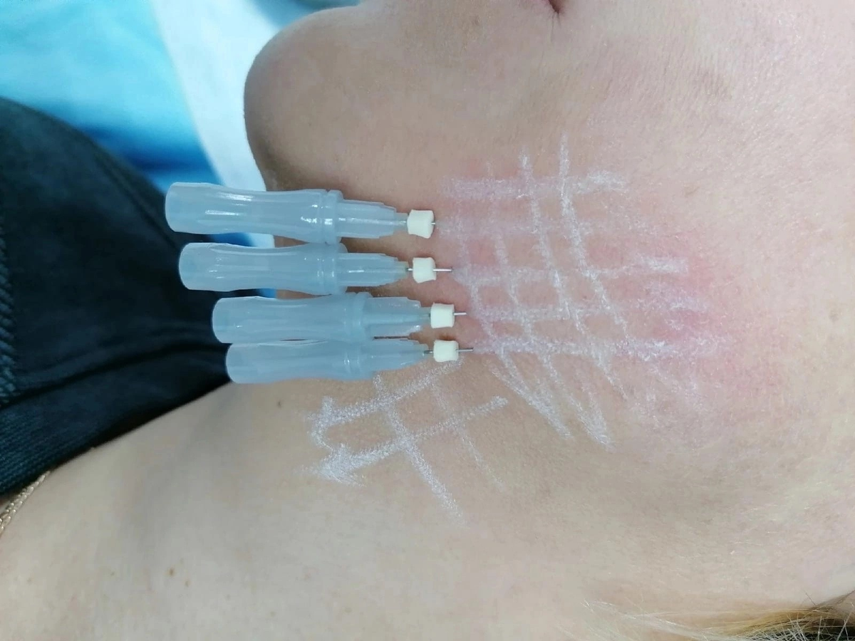 💎Омоложение мезонитями - популярная и эффективная anti-age процедура. 💎Мезонити разглаживают возрастные складки и глубокие морщины . Мезонити буквально подтягивают Ваше лицо, обеспечивая долгосрочный лифтинг-эффект.
Армирование позволяет создать естественный поддерживающий каркас, который гармонично интегрируется в ткань, не вызывая внутреннего дискомфорта и внешне заметных деформаций. Процедура может быть применена к четырем зонам лица:
💎 брови: подтяжка наружного края бровей и подчеркивание взгляда;
💎щечно-скуловая область: разглаживаются носогубные складки, подтягивается вся средняя зона лица;
💎 «брыли»: подтягивается и разглаживается овал лица - это основное показание
💎шея: разглаживание морщин, подтяжка кожи.