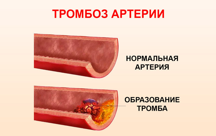 Схема образования сгустка в просвете сосуда