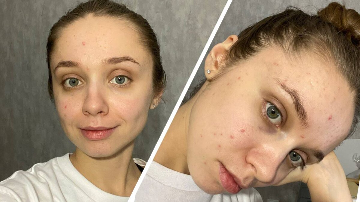 Моё лицо до использования некамедогенного масла