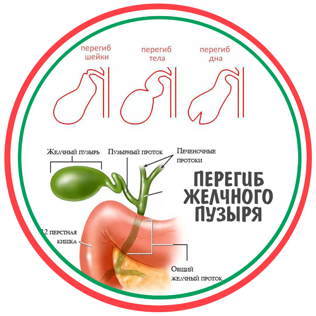 Загиб желчного пузыря что делать. Загиб желчного пузыря у ребенка на УЗИ. Желчный пузырь Перегиб н/з. Перетяжка шейки желчного пузыря. Перегиб протока желчного пузыря.