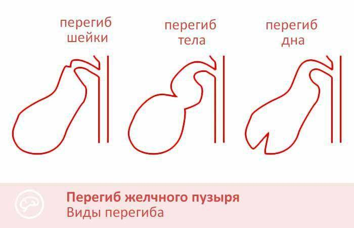 ГБУЗ «Туапсинская районная больница №1» МЗ КК - Перегиб желчного пузыря – что это?