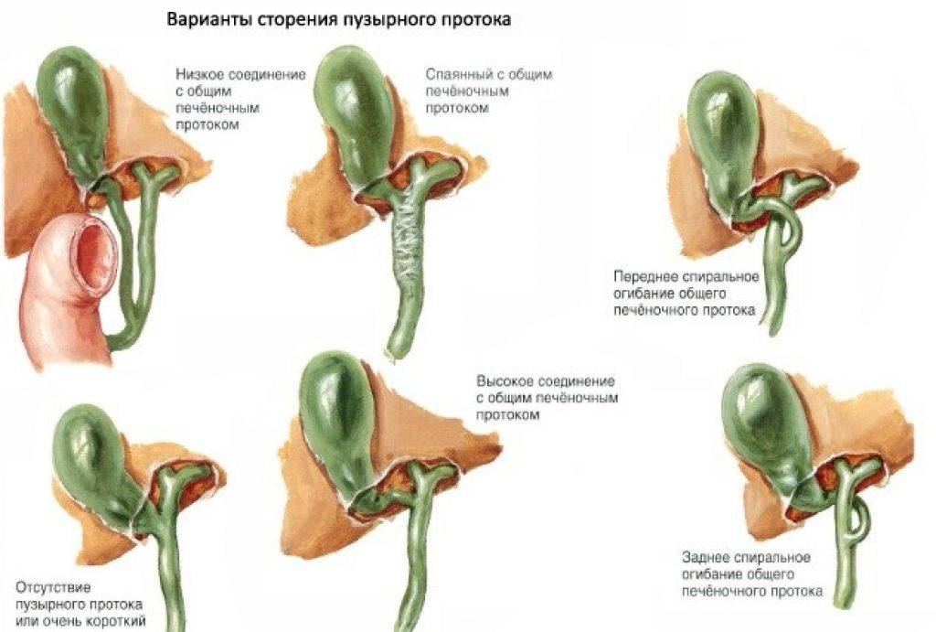 Проток форум. Желчный пузырь с перегибами в области шейки и тела. Форма желчного пузыря с перегибом. Изогнутая форма желчного пузыря. S образный Перегиб желчного пузыря