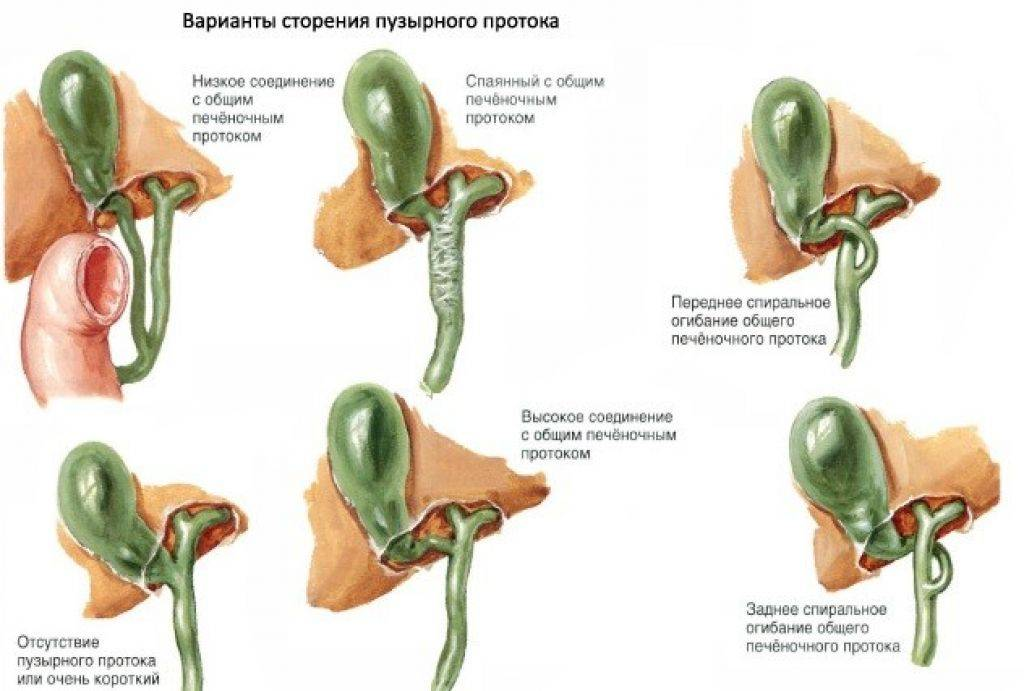 Желчный пузырь как лечить в домашних условиях. Желчный пузырь с перегибами в области шейки и тела. Желчный пузырь форма с перегибом в теле. S образный Перегиб желчного пузыря. S образный загиб желчного пузыря.