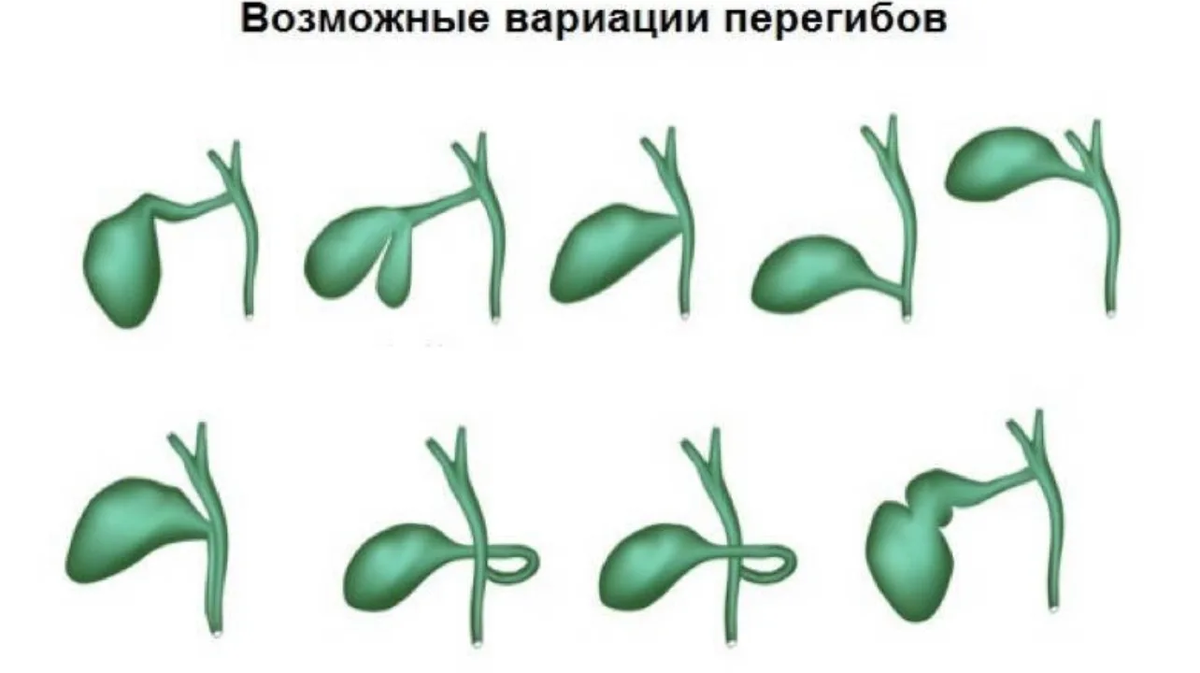 Желчный деформирован перегибом