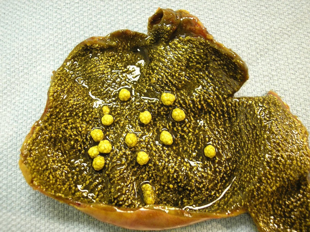 Удаленный желчный пузырь с холестерозом и холестериновыми псевдополипами.