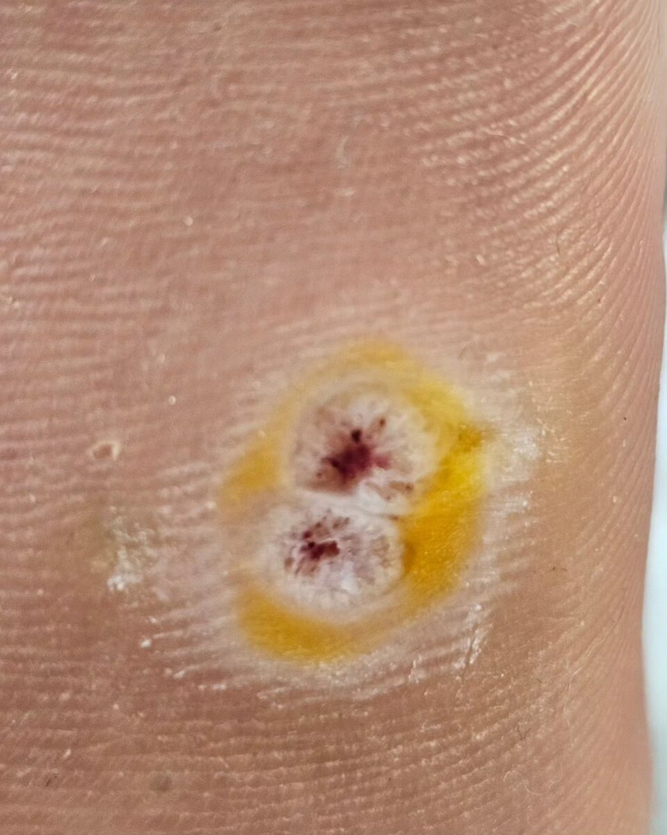 Удаление азотной кислотой