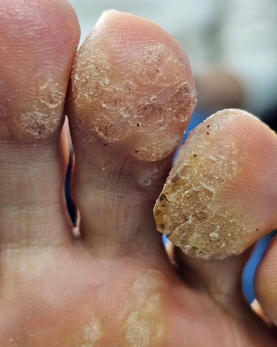 Подошвенные бородавки