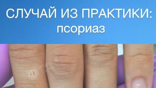 КЛИНИКА ПОДОЛОГИИ ПОЛЁТ | СЛУЧАЙ ИЗ ПРАКТИКИ: псориаз / лечение ногтей ...