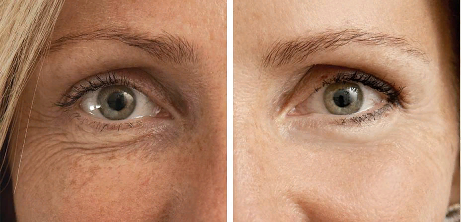 Самый распространенный вид пигментации