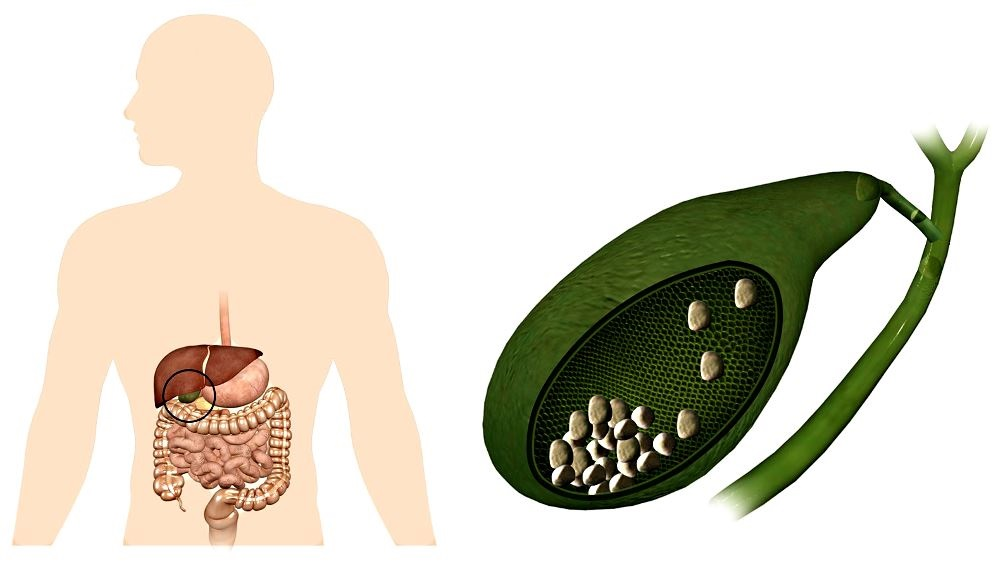 Желчнокаменная болезнь и холецистит. ЖКБ конкременты желчного пузыря. Желчный пузырь желчнокаменная болезнь. Холецистит камни в желчном пузыре.