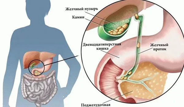 Желчный пузырь с камнями картинка