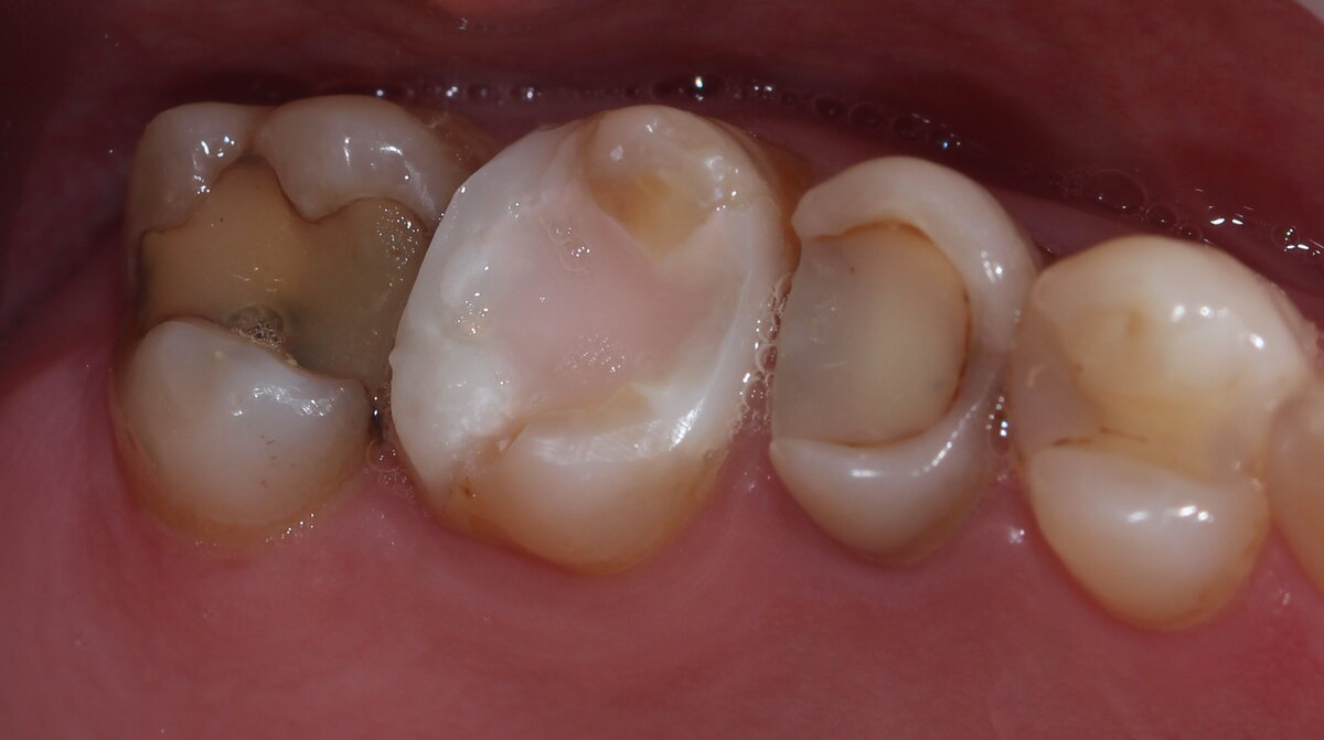 Типичные "залепухи" из светового композита. Форма зубов анатомически даже близко не восстановлена, вокруг почти всех пломб присутствует вторичный кариес (крайний зуб был пролечен давно, судя по виду, соседние - не так давно, в пределах 2-5 лет).  