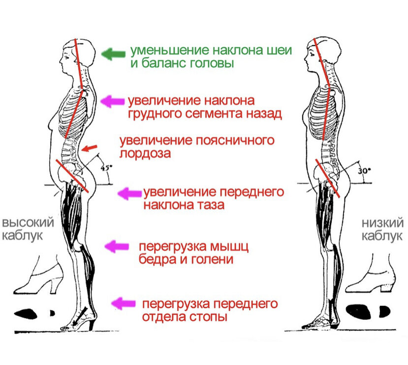 Спазмы мышц поясничного отдела. Влияние каблуков на осанку. Влияние высоких каблуков на позвоночник. Каблуки и позвоночник. Нагрузка на позвоночник на каблуках.
