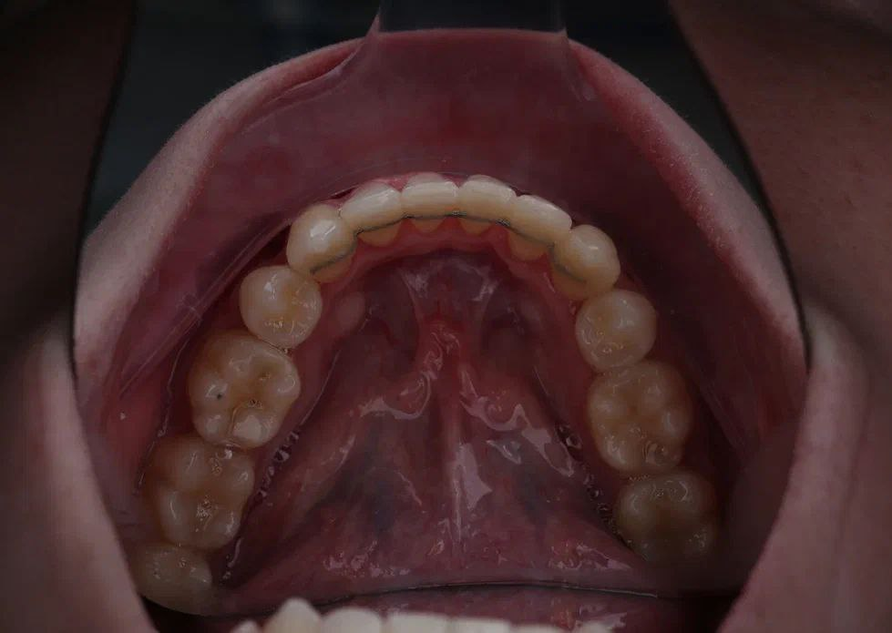 Так как ретейнер устанавливают с внутренней стороны зубов, то его видит только стоматолог при осмотре.