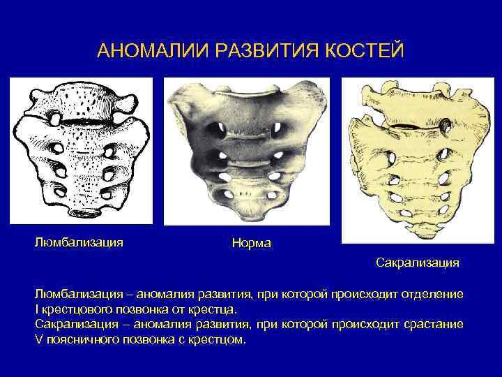 Кстати, прочитала что это тоже увеличивает риск защемления нерва. Может оно и произошло у меня. 