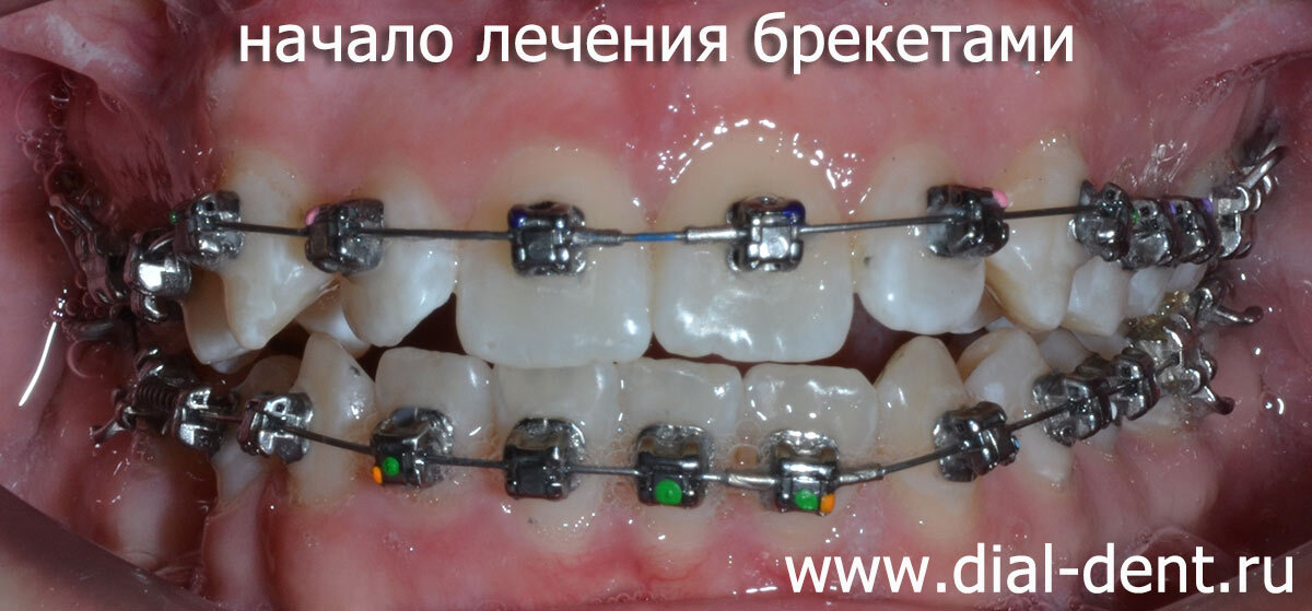 лечение брекетами Damon
