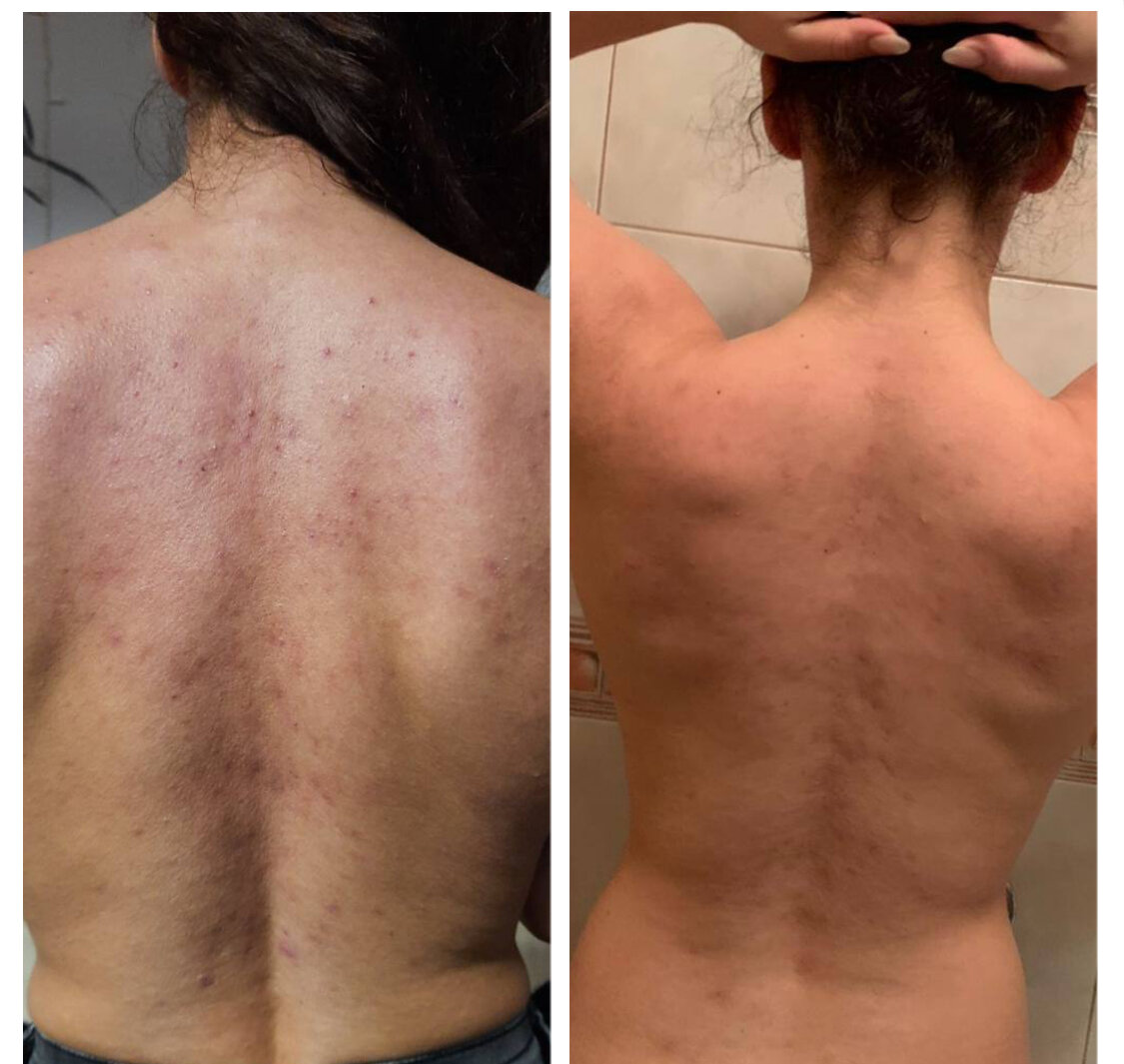 До/после лечения