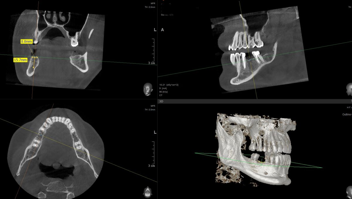8.8 мм в ширину и 15.7 мм до нижнечелюстного нерва!