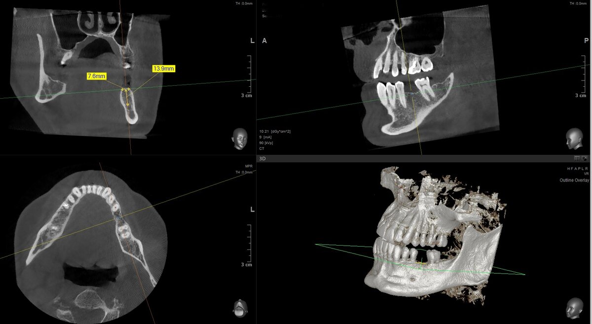 7.6 мм в ширину и 13.9 мм до нижнечелюстного нерва!