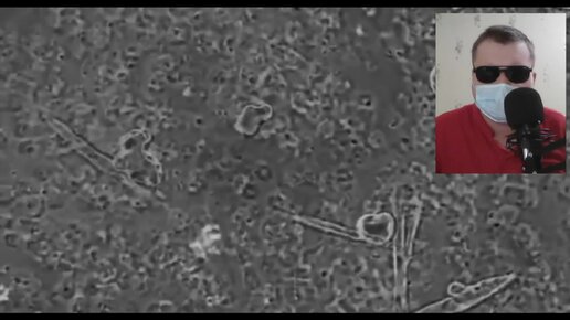 Выдавливание прыща при большом увеличении(гной под микроскопом). Зачем ...