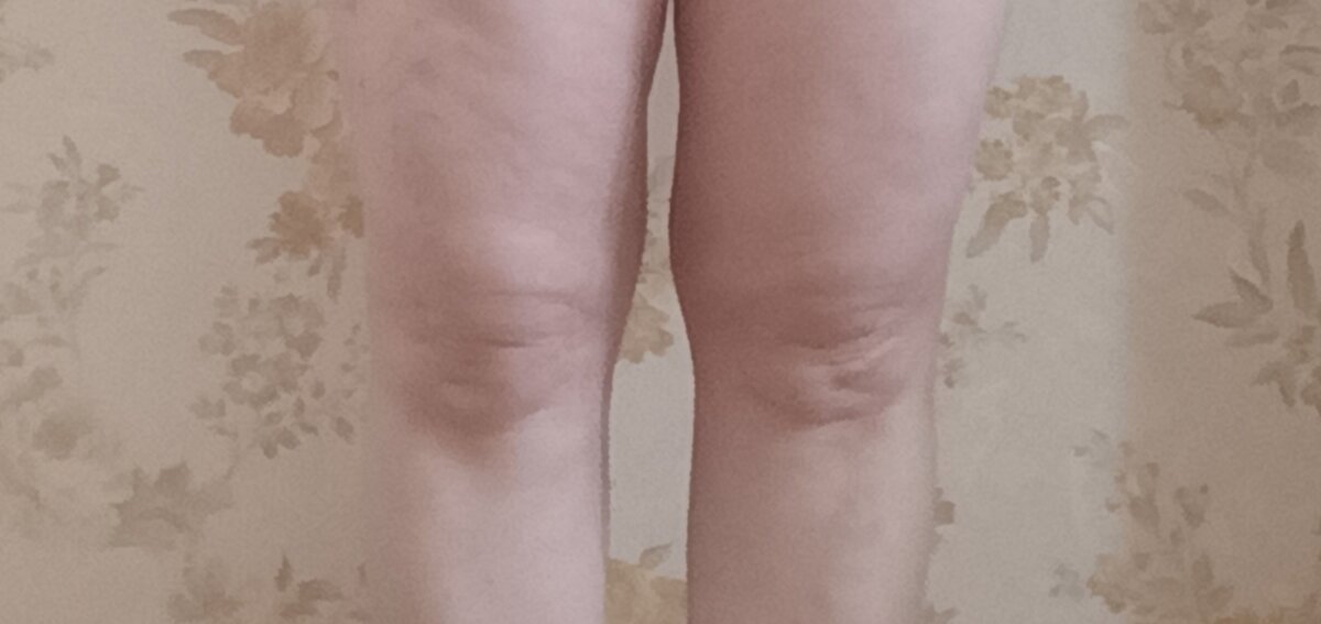 О- образная деформация коленных суставов 