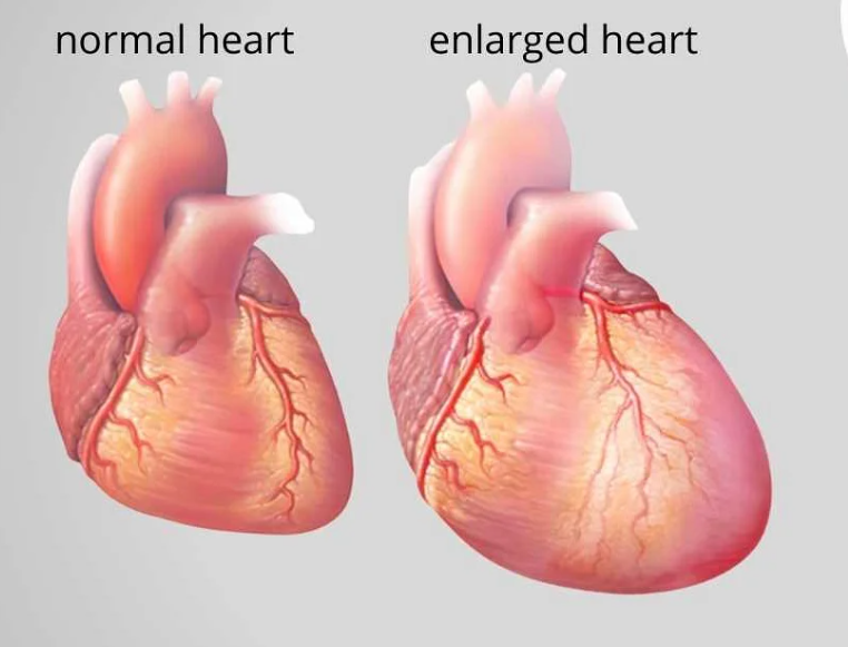 Кардиомегалия (увеличенное сердце): причины, симптомы, диагностика, лечение