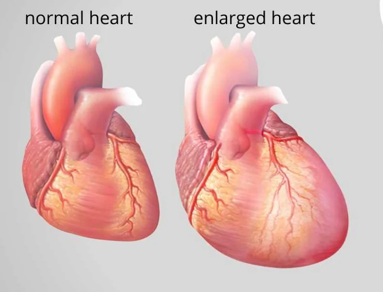 Увеличение сердца симптомы