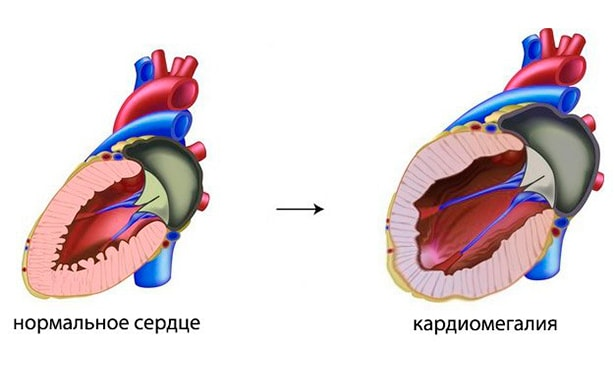 Гипертрофия правого желудочка