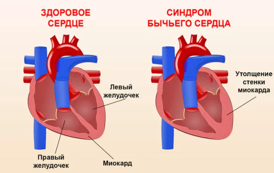 Незначительный увеличение сердца. Бычье сердце заболевание. Бычье сердце диагноз у человека что это такое.