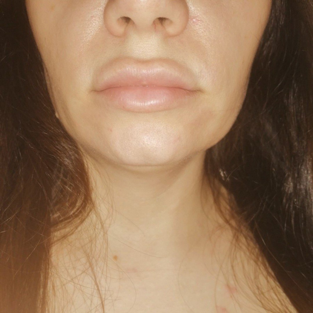 Почему уходят губы. Губы до и после гиалуронидазы. Усы от гиалуроновой кислоты.