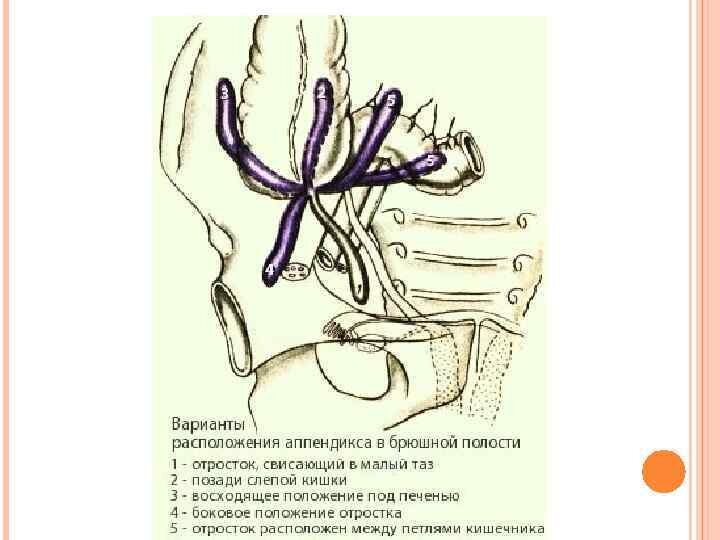 Аппендицит схема расположения