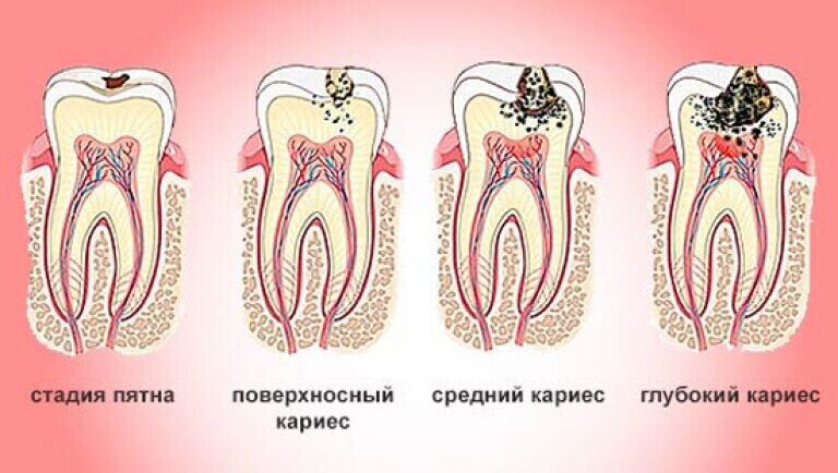 1 стадия кариеса