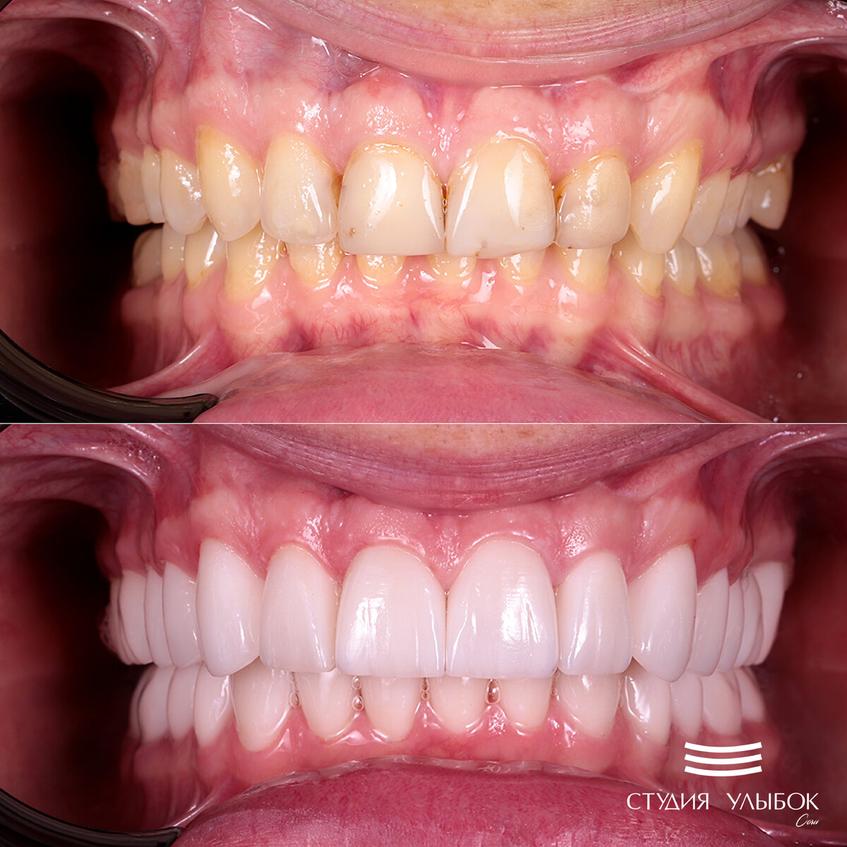 Обзор 'до" и "после" ортодонтического и терапевтического лечения зубов с примением эстетической реставрации зубов