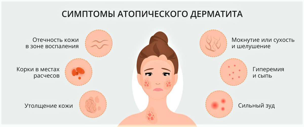 Причины возникновения перхоти.