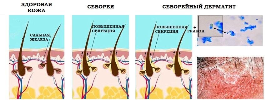 Причины возникновения перхоти.