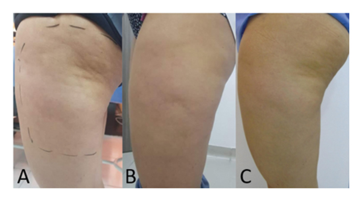 Фото 1. Кожа пациента до (A), через 20 дней после лечения (B) и через 3 месяца после лечения (C).